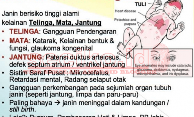 Apa itu Rubella? dan Bagaimana Tanda-Tanda dan Gejala Rubella?
