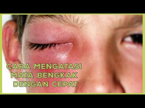 Video Mata Memerah dan Bengkak ?? Begini Cara Mengobati Mata Bengkak ! 2021