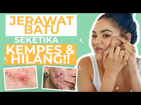 Video JANGAN PANIK! Ini 6 Cara Menghilangkan Jerawat Batu di Wajah! 2021