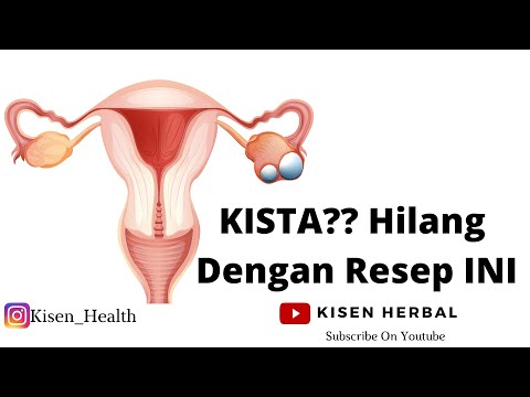 Video CARA MENGOBATI KISTA OVARIUM PAKAI RACIKAN ALAMI !!!!! 2021