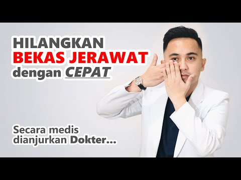 Video Cara Menghilangkan BEKAS JERAWAT (PIH) secara Medis 2021