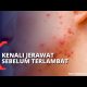 Video Cara Mencegah dan Mengatasi Jerawat pada Kulit 2021