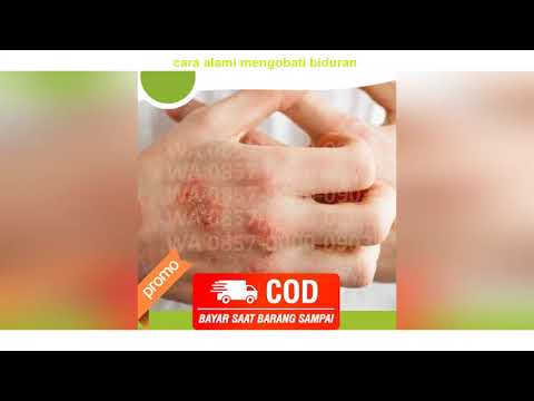 Video WA 0857-0000-0903 cara alami mengobati biduran 2021