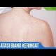 Atasi biang keringat dengan cara ini !! / Go Dok Indonesia 2021