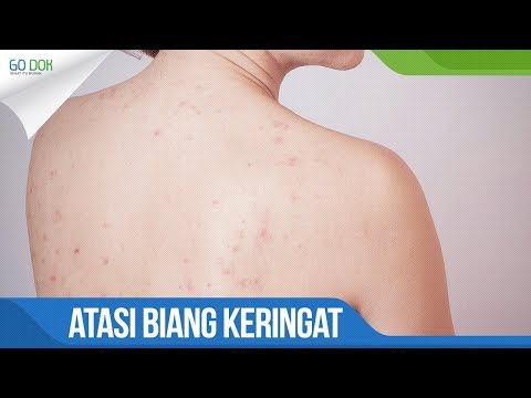Atasi biang keringat dengan cara ini !! / Go Dok Indonesia 2021