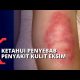 Cara Mencegah Penyakit Kulit Dermatitis Atopik atau Eksim 2021 Cara Mencegah Penyakit Kulit Dermatitis Atopik atau Eksim 2021